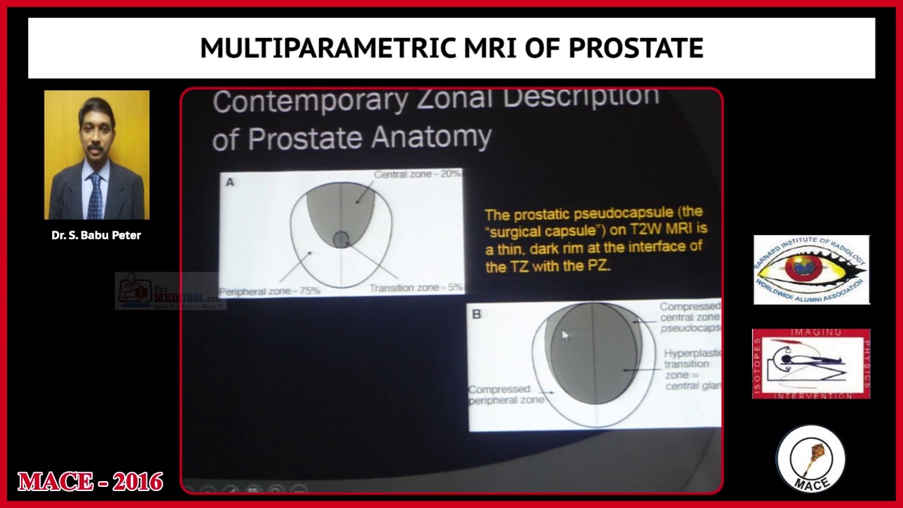 Tralier Multiparametric MRI of Prostate - YouTube