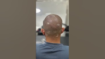 Scalp viet nam, smp hanoi Xăm tóc hói đỉnh đầu, #reviewxămtóc #xămtóc