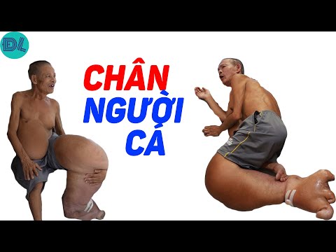 Chân khổng lồ khiến người trông như nàng tiên cá - ĐỘC LẠ BÌNH DƯƠNG