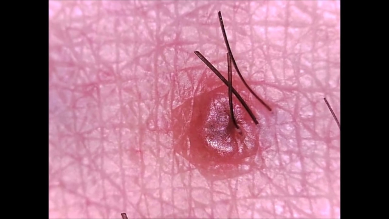 Extreme Medical Trivia! Staph, Cysts, Boils and Infection! YouTube