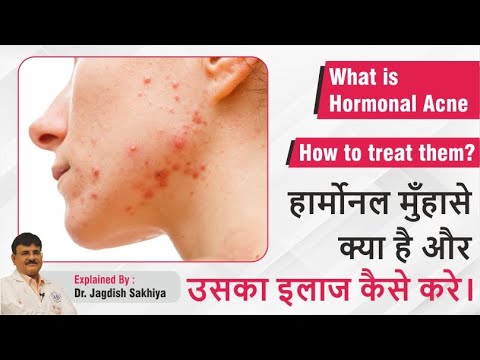 वीडियो: क्या ल्यूटिनाइजिंग हार्मोन के कारण मुंहासे होते हैं?