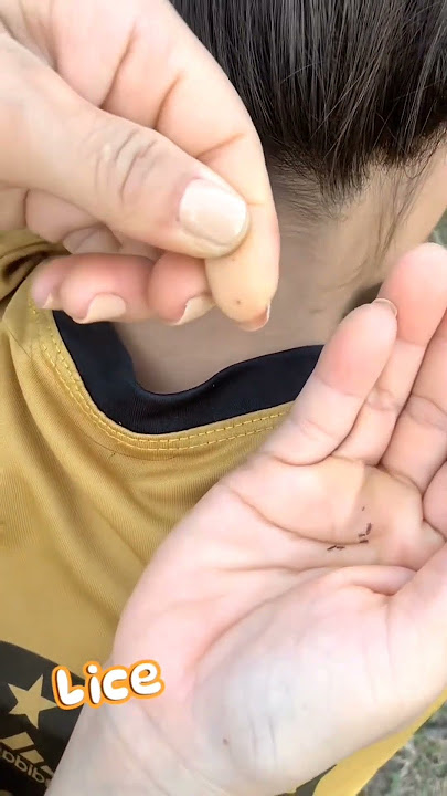 Cleaning lice part 2 #lice #shortsviral #shortsfeed #shortsvideo #shorts