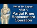 What To Expect After A Partial Knee Replacement Operation