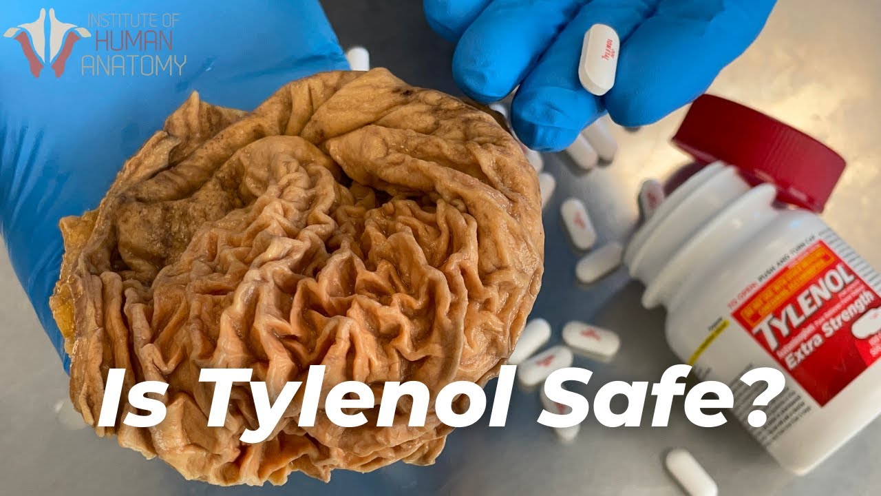 Should You Stop Taking Tylenol? (Acetaminophen/Paracetamol)