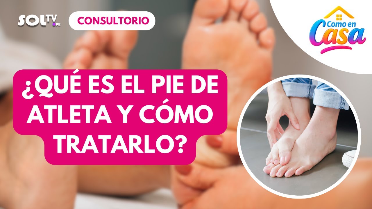 ¿Qué es el pie de atleta y cómo tratarlo?