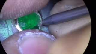 Klever Ruiz (Emerald Stone Setting)