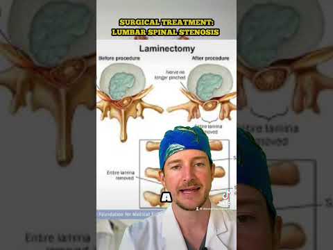 Video: Kapan stenosis memerlukan pembedahan?