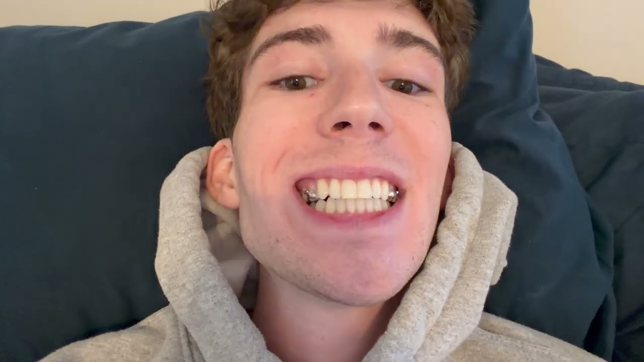 MARPE Update #1 | Install