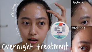PAANO GAMITIN ANG BIODERM OINTMENT FOR ACNE (OVERNIGHT PIMPLE TREATMENT) | I am Marta Cervanez