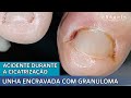 ACIDENTE DURANTE A CICATRIZAÇÃO | UNHA ENCRAVADA COM GRANULOMA