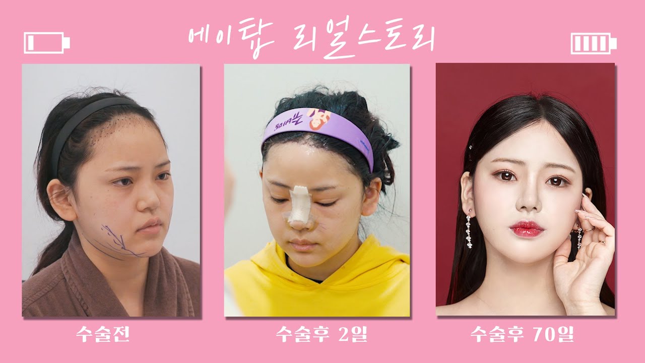 [Эйтоп Гоо Сайхны Эмнэлэг] Мэс заслын дараах 2 дахь өдөр, тод илэрсэн өөрчлөлт! "Талбай шиг дух"-тай одоо баяртай, Эх орондоо буцахаас өмнө хамрын гоо сайхны