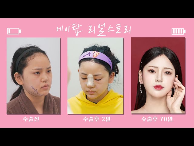 수술 후 2일째, 확 드러나는 변화! “운동장 이마” 이제 짜이찌엔, 귀국전에 코성형, 여우리프팅,이마축소술 한번에/ 에이탑성형외과/韩国爱她整形外科医院