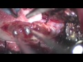 Ventral Approach to Intramedullary Spinal Cord Tumor