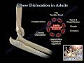 Elbow Dislocation In Adults - Everything You Need To Know - Dr. Nabil Ebraheim