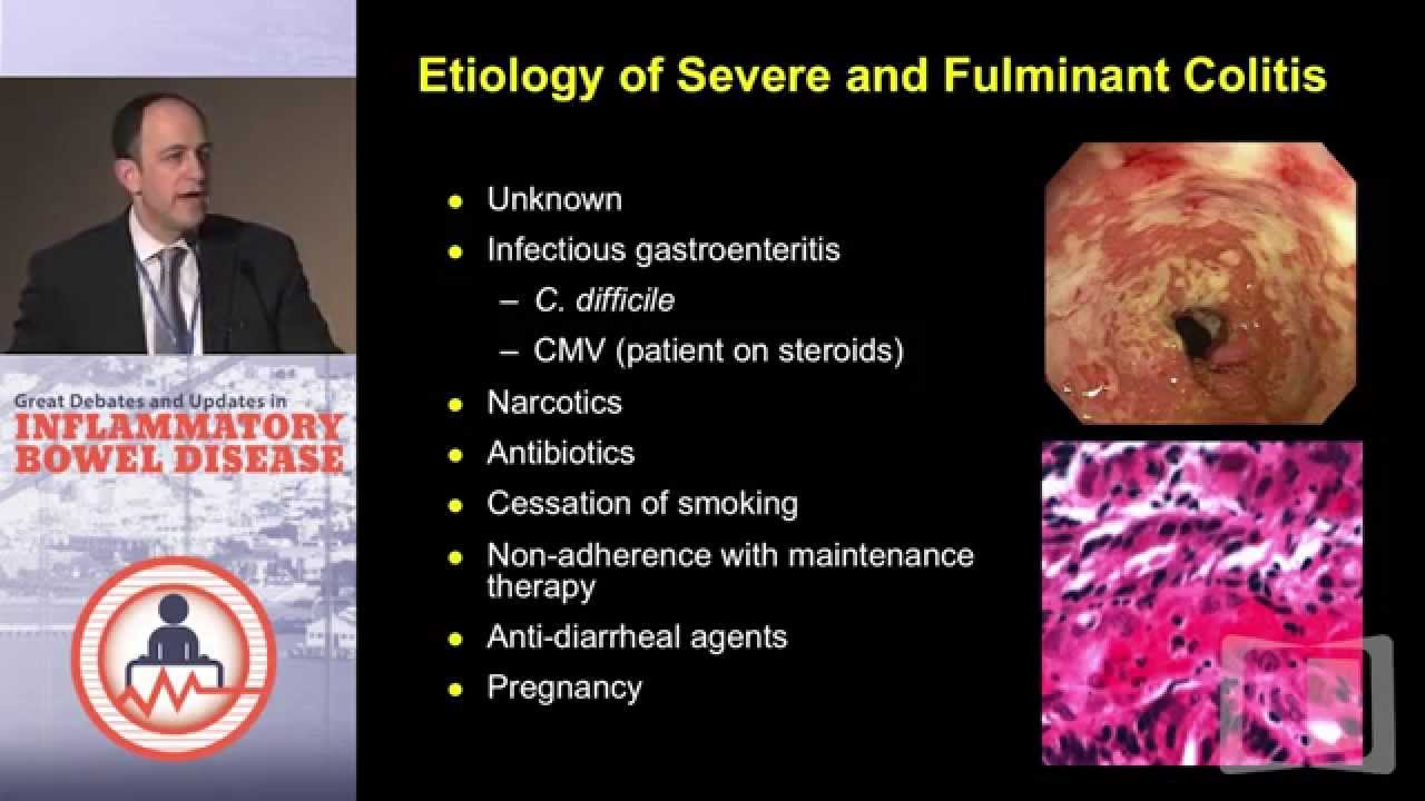 Treatment Strategies for the Acute Severe Ulcerative Colitis Patient