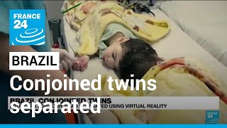 Brazil: Conjoined twins separated with help of virtual reality • FRANCE 24 English