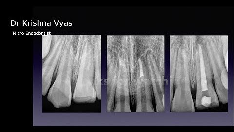 open apex MTA apical plug