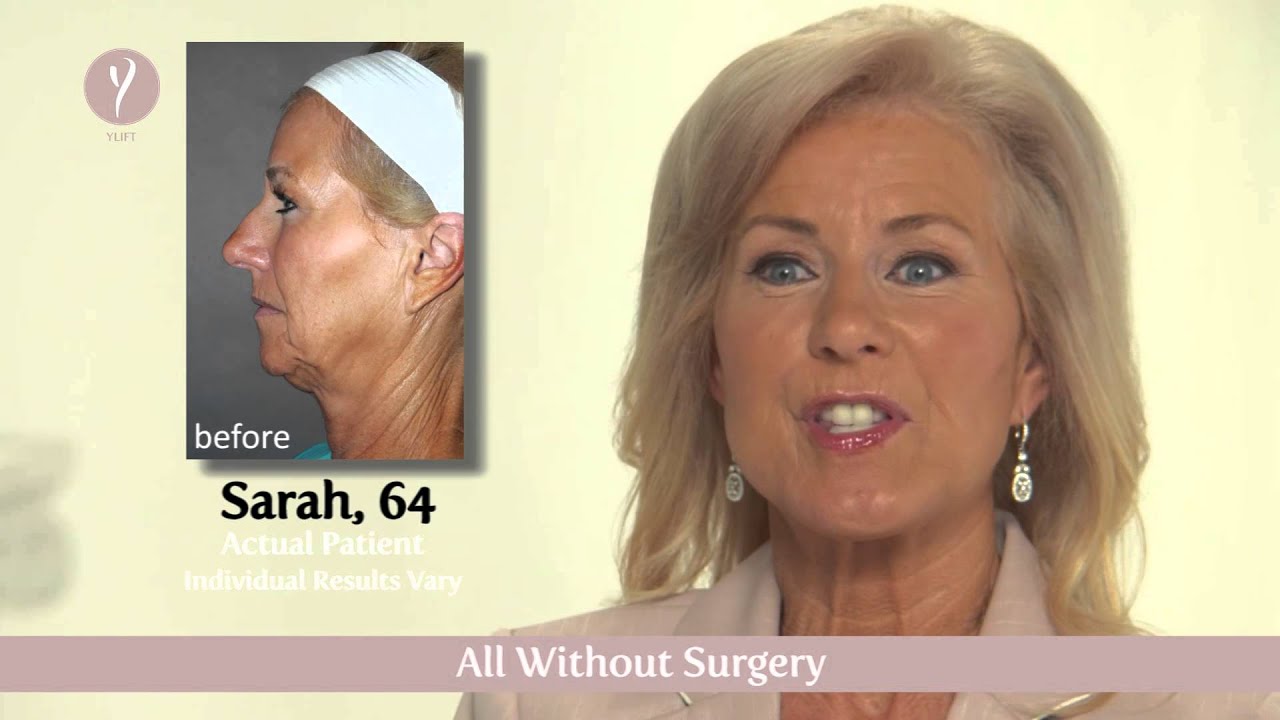 Skin & Vein YLift FaceLift All about the YLift Face Lift in