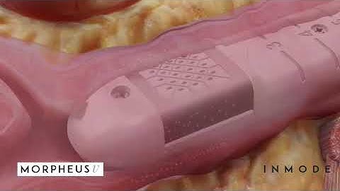 Morpheus8V - How It Works