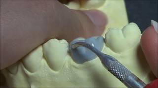 Live wax up - Lower 1st molar(contour)