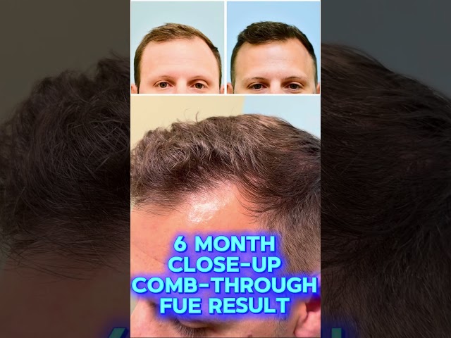 6 month closeup, comb-through FUE transplant result with Dr. Lam