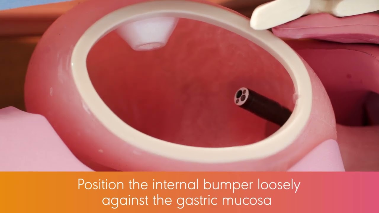 Avanos CORFLO PEG In Service