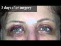 Upper Eyelid Surgery Before & After Photos 3 Days Post Surgery | 8 West Clinic in Vancouver, BC