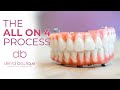 All on implants the process at dental boutique