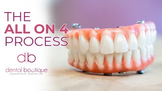 All on Implants The Process At Dental Boutique