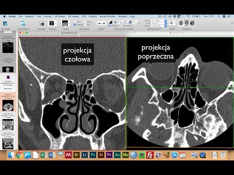 Wideo: Wpływ Obrazowania CT Z Podwójną Energią Na Obliczenia Dawki W Badaniach Przedklinicznych