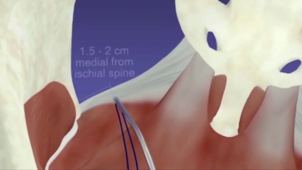 pelvic organ prolapse pelvic organ prolapse