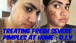 Hello, suddenly due to location change, my sensitive skin welcomes a
large number of small and red uninvited guests on face.these pimples
are pain i...