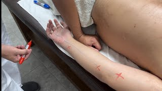 Как Убрать Онемение В Мизинце?! Deep Tissue Massage.миопрессура Предплечья