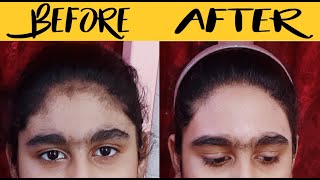 (New) How to Remove Facial Hair permanently at home|| How To Remove Forehead Easy at home