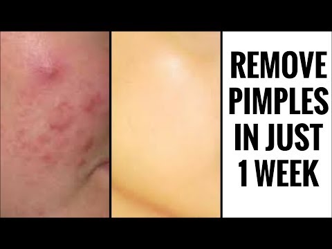 GET RID OF ACNE & ACNE SCARS IN JUST  WEEK | GUARANTEED LESS ACNE | ACNE TREATMENT % SUCCESS
