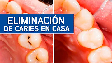 ¿Cómo evitar que la caries huela?