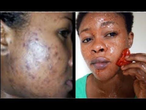 Come eliminare le macchie scure sul viso e sul corpo con il pomodoro e...