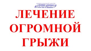 Лечение большой грыжи диска позвоночника 12.8 мм