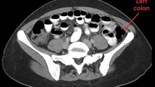 Abdomen and Pelvis CT Search Pattern in 5 minutes