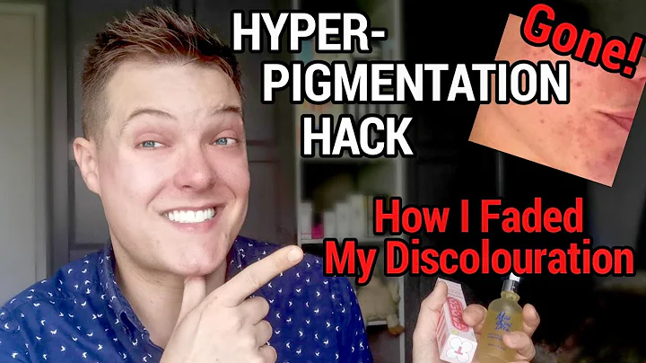 HYPERPIGMENTATION - How To Use Azelaic Acid and Tranexamic Acid for Dark Spots