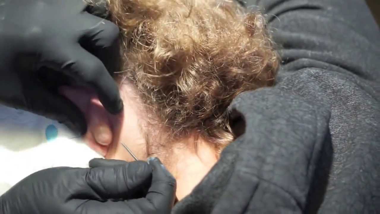 Popping large cyst behind ear - YouTube