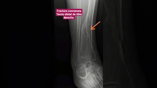 FRACTURA DE TIBIA TERCIO DISTAL