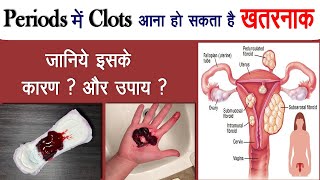 पीरियड्स के दौरान कितना Clots आना हो सकता है खतरनाक || पीरियड्स के बाद खून की कमी को कैसे दूर करें