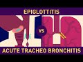 Pediatric respiratory illnesses: Croup (Acute Laryngo-tracheo-bronchitis) and Epiglottitis