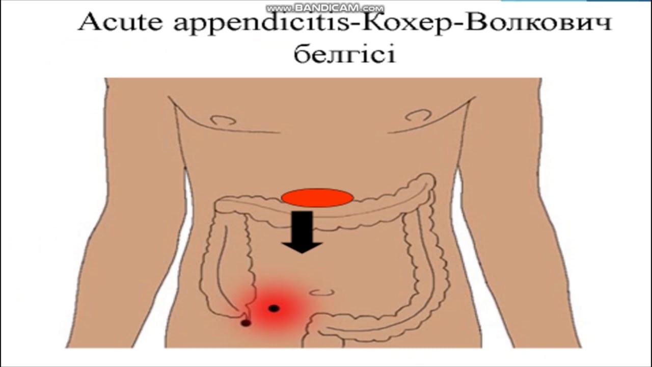 Аппендицит щеткин блюмберг