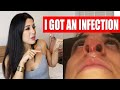 I GOT AN INFECTION! | Nose Job 2 month update | Q&A | PART 5