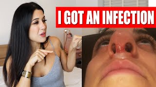 I GOT AN INFECTION! | Nose Job 2 month update | Q&A | PART 5