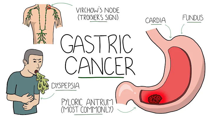 Gastric Cancer - An Overview for Students and Junior Doctors (Including Troisier's Sign) - DayDayNews