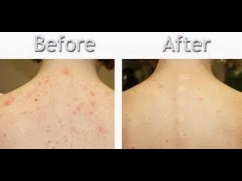  Ways to Get Rid Of Back Acne Fast and Naturally Part 