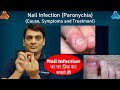 Nail Infection (Paronychia) - Cause & Treatment |  नाखून संक्रमण का इलाज कैसे करें? (Dr. Puspendra)